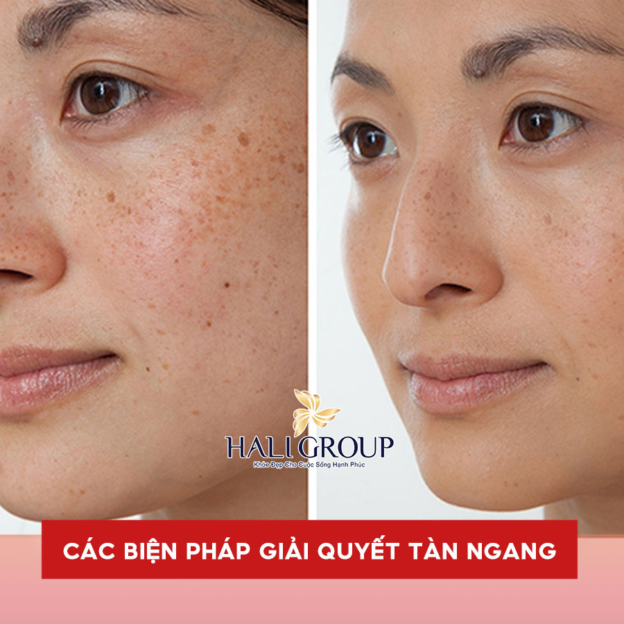 cách giải quyết tàn nhang